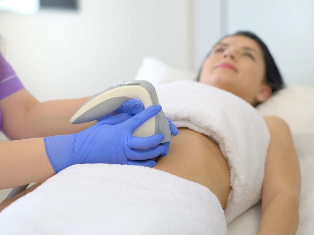 coolsculptarea elimină permanent celulele grase